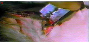 Eyeball slice from New York Ripper